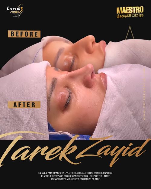 مخاطر عمليات تجميل الأنف